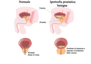 Ipertrofia_prostatica_benigna