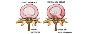 ernia_fuoriuscita