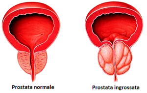 ipertrofia-prostatica1