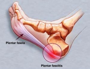 noene-fascite-plantare-solette-antishock